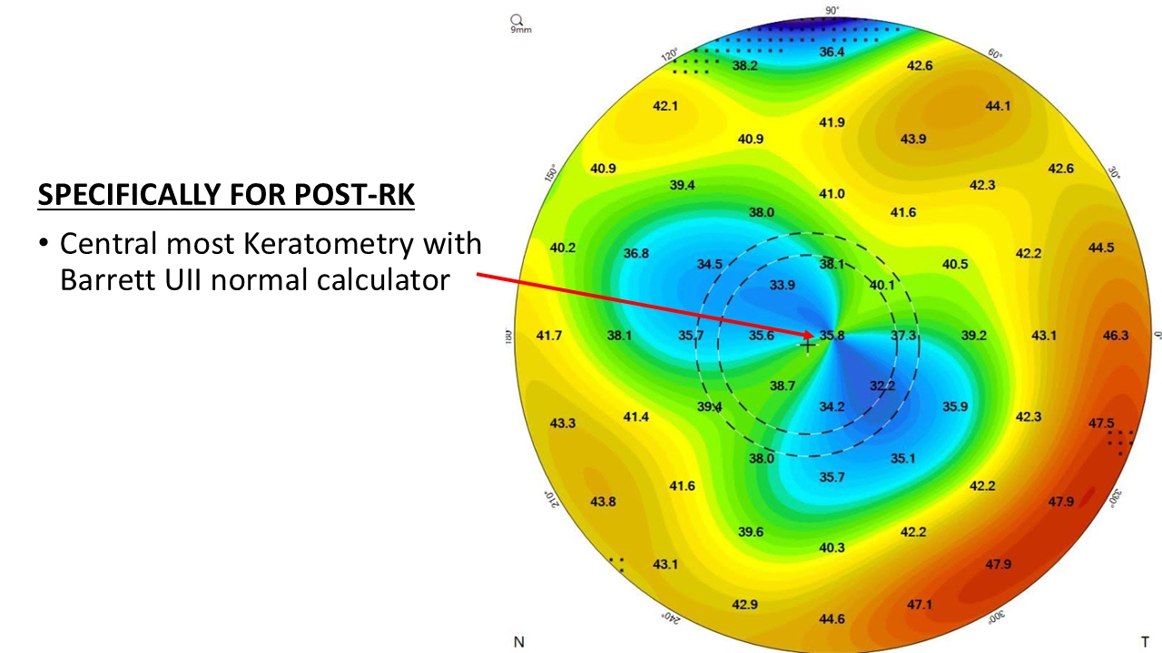 Post-RK corneal topography map showing the centralmost K value (35.8 D) indicated by a red arrow — this value is entered as both K1 and K2 in Barrett Universal II